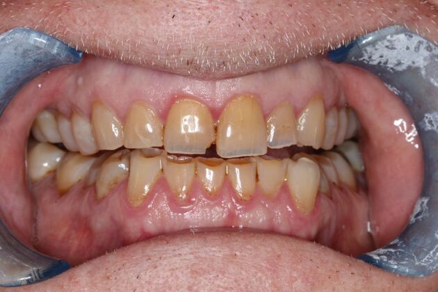 Veneers: Case 33 - Before