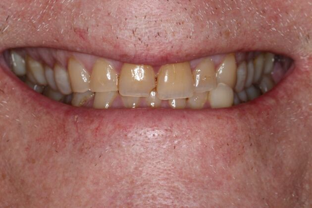 Veneers: Case 33 - Before