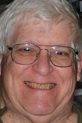 Veneers Case 33 - Before