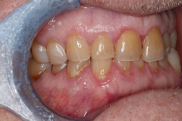 Veneers: Case 33 - After