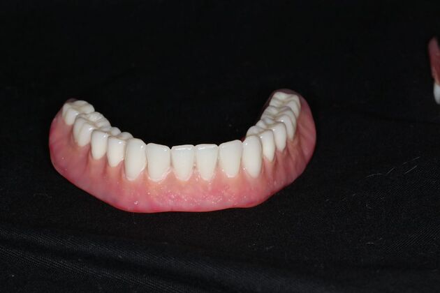 Dentures Case 19 - Before