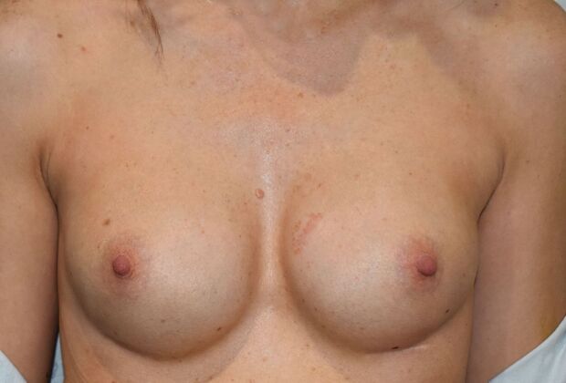 Breast Revision: Case 220 - Before