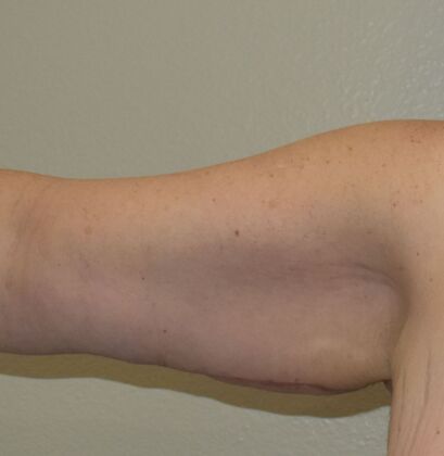 Brachioplasty Case 18 - After