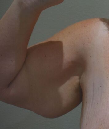 Brachioplasty Case 18 - Before