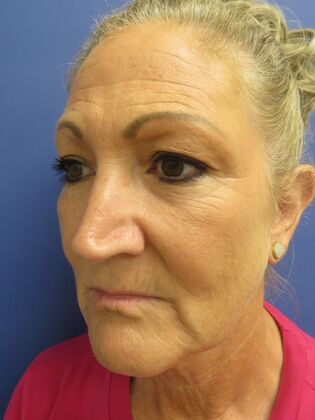Facelift / RestoreLift Case 22 - Before