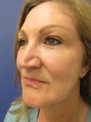 Facelift / RestoreLift Case 22 - After