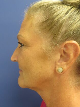 Facelift / RestoreLift: Case 22 - Before