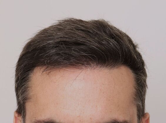 Male Before And After Hair Transplant Photos Hairline FUE (17) - After