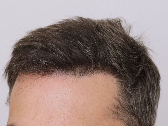 Hair Transplant - Male: Hairline FUE - Case 17 - After FUE hair transplant