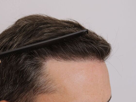 Hair Transplant - Male: Hairline FUE - Case 17 - After FUE hair transplant