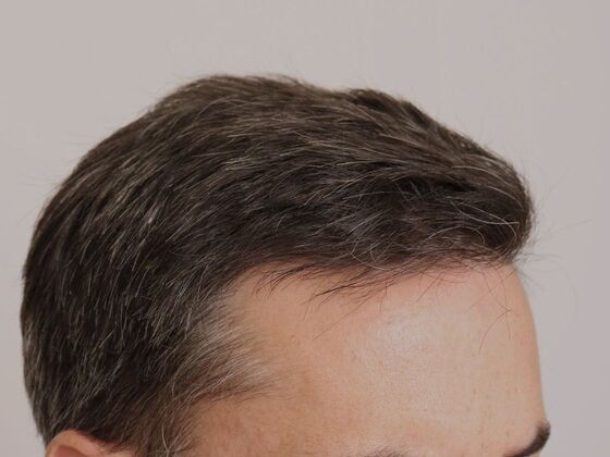 Hair Transplant - Male: Hairline FUE - Case 17 - After FUE hair transplant