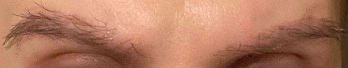 Facial Hair Transplantation: Case 3 - After