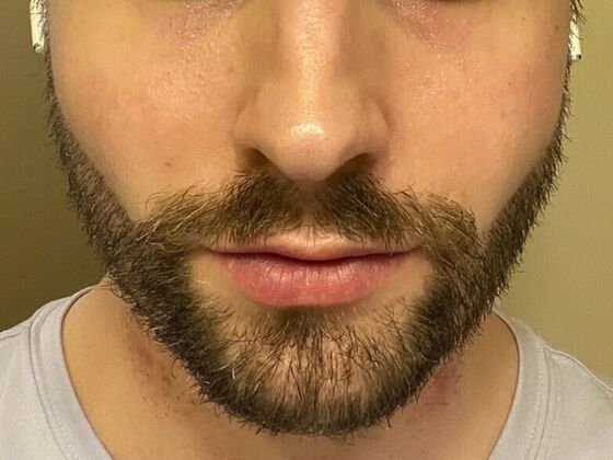 Facial Hair Transplantation Case 3 - After