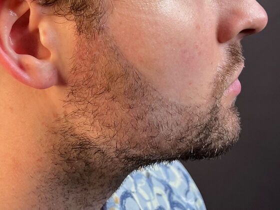 Facial Hair Transplantation: Case 3 - Before