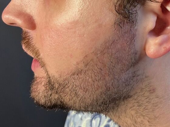 Facial Hair Transplantation: Case 3 - Before