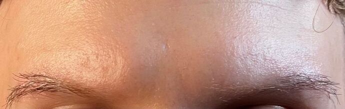 Facial Hair Transplantation: Case 3 - Before