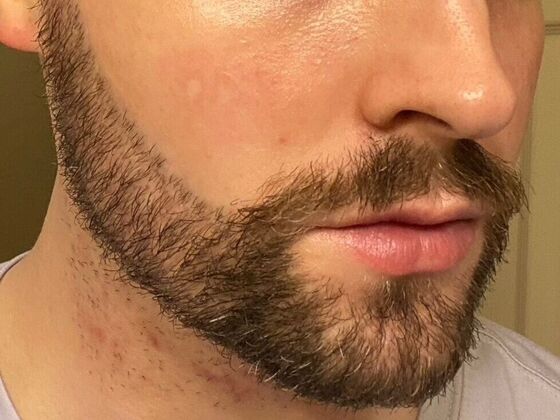 Corrective Hair Restoration: Case 5 - After