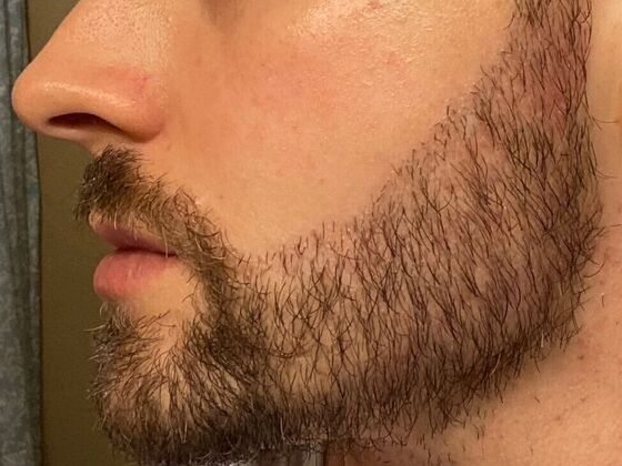 Corrective Hair Restoration: Case 5 - After