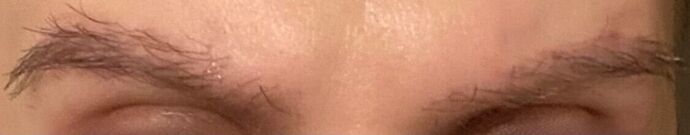 Corrective Hair Restoration: Case 5 - After