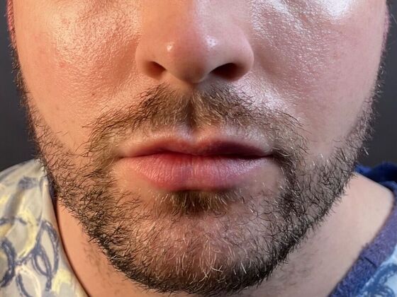 Corrective Hair Restoration: Case 5 - Before