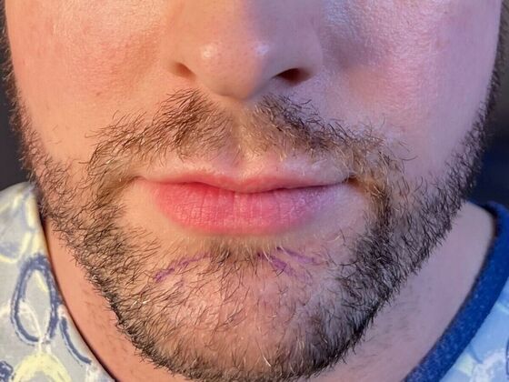 Corrective Hair Restoration Case 5 - Before