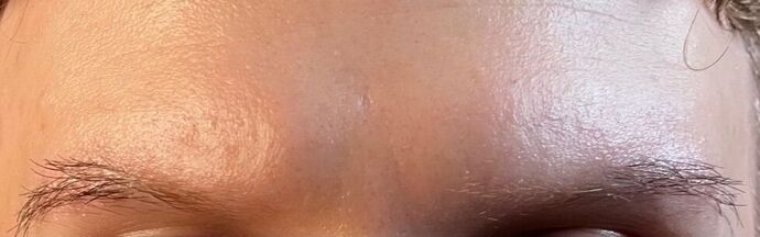 Corrective Hair Restoration: Case 5 - Before