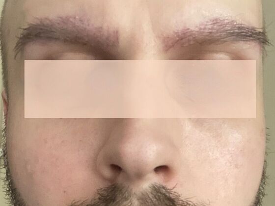 Facial Hair Transplantation: Case 3 - 3 months post-op