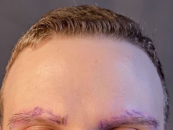 Facial Hair Transplantation: Case 3 - Before