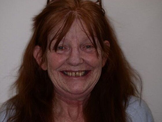 Full Mouth Reconstruction: Case 1 - Before