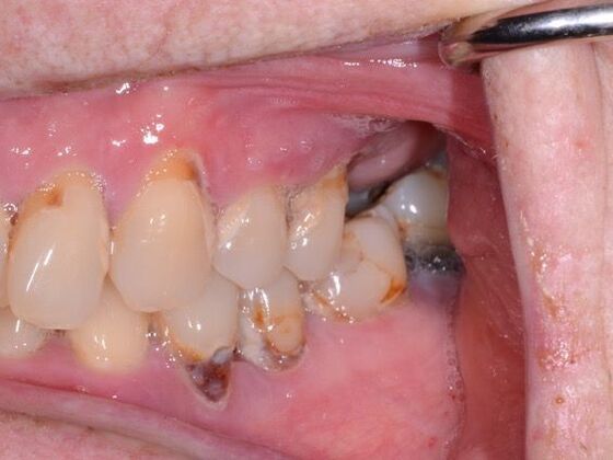 Full Mouth Reconstruction: Case 1 - Before