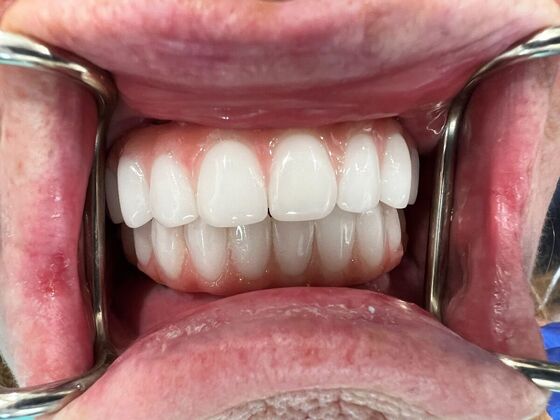 Full Mouth Reconstruction: Case 1 - After