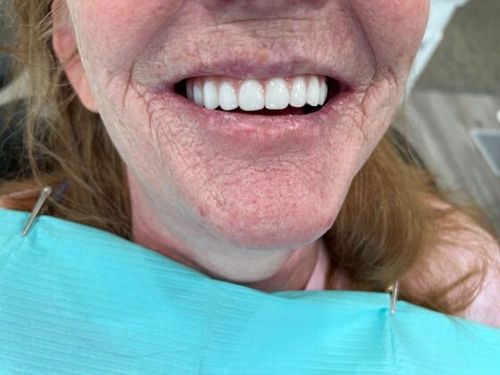 Full Mouth Reconstruction: Case 1 - After