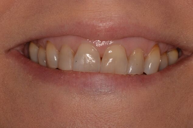 Porcelain Veneers Case 33 - Before
