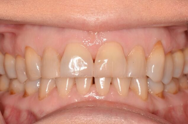 Porcelain Veneers: Case 33 - Before