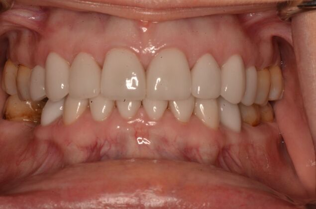 Porcelain Veneers: Case 33 - After