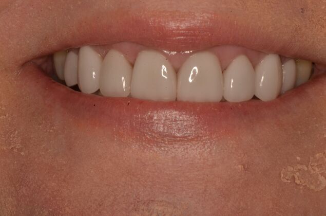 Porcelain Veneers Case 33 - After
