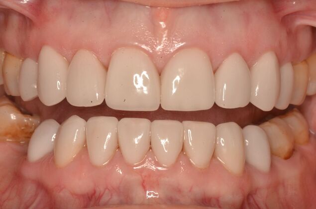 Porcelain Veneers: Case 33 - After