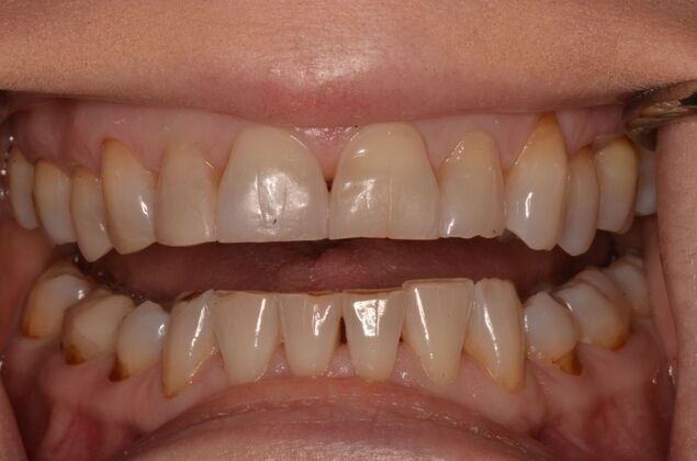 Porcelain Veneers: Case 33 - Before