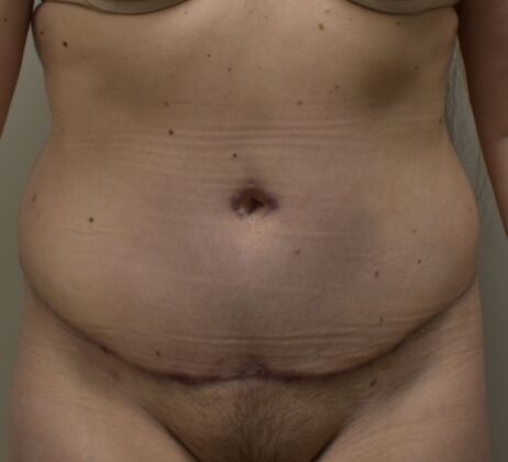 Tummy Tuck (Abdominoplasty): Case 418 - After