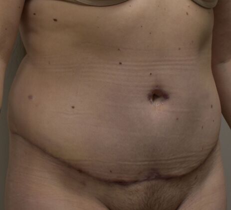 Tummy Tuck (Abdominoplasty): Case 418 - After