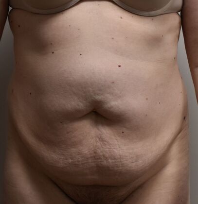 Tummy Tuck (Abdominoplasty): Case 418 - Before