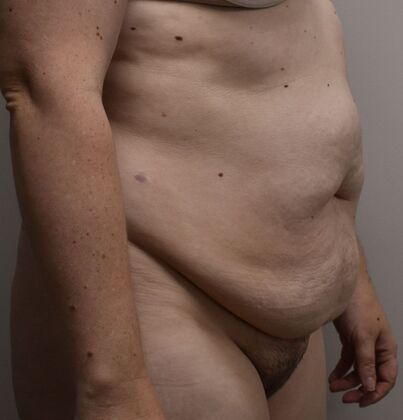 Tummy Tuck (Abdominoplasty): Case 418 - Before