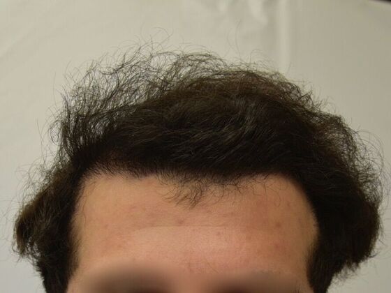 FUT Hair Restoration Case 28 - After