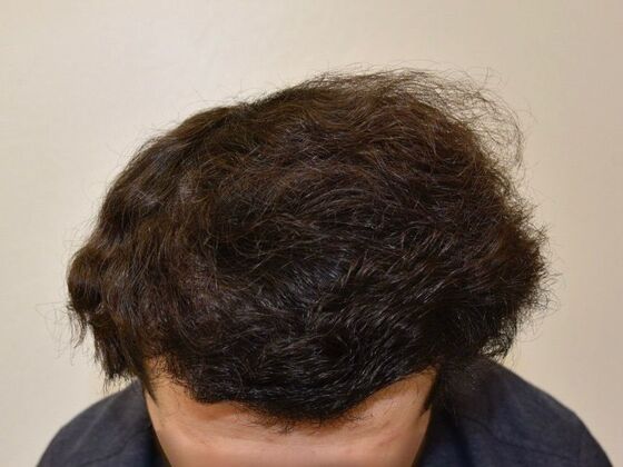 FUT Hair Restoration: Case 28 - After
