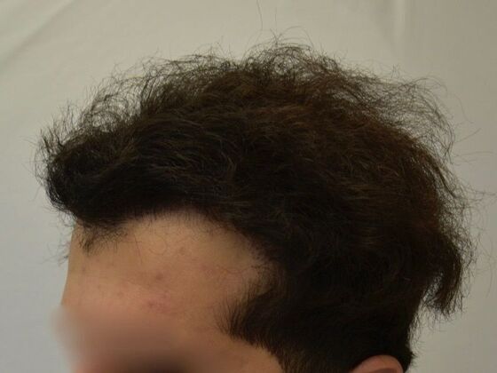 FUT Hair Restoration: Case 28 - After