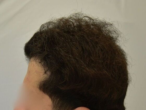 FUT Hair Restoration: Case 28 - After