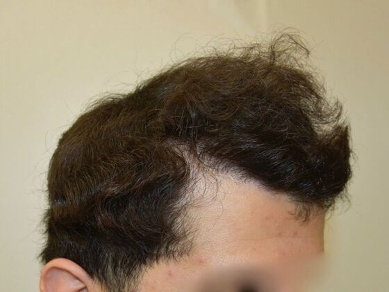 FUT Hair Restoration: Case 28 - After