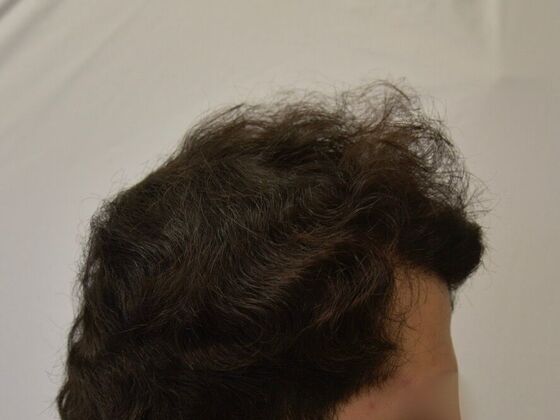 FUT Hair Restoration: Case 28 - After