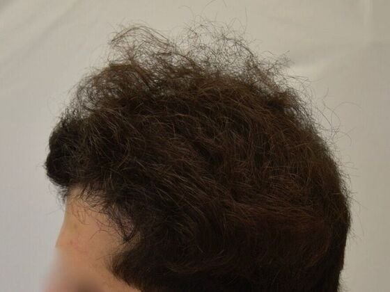 FUT Hair Restoration: Case 28 - After