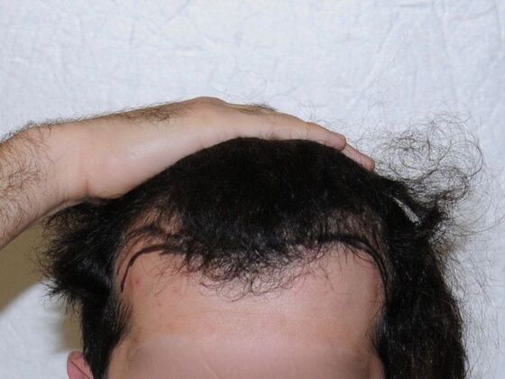 FUT Hair Restoration Case 28 - Before